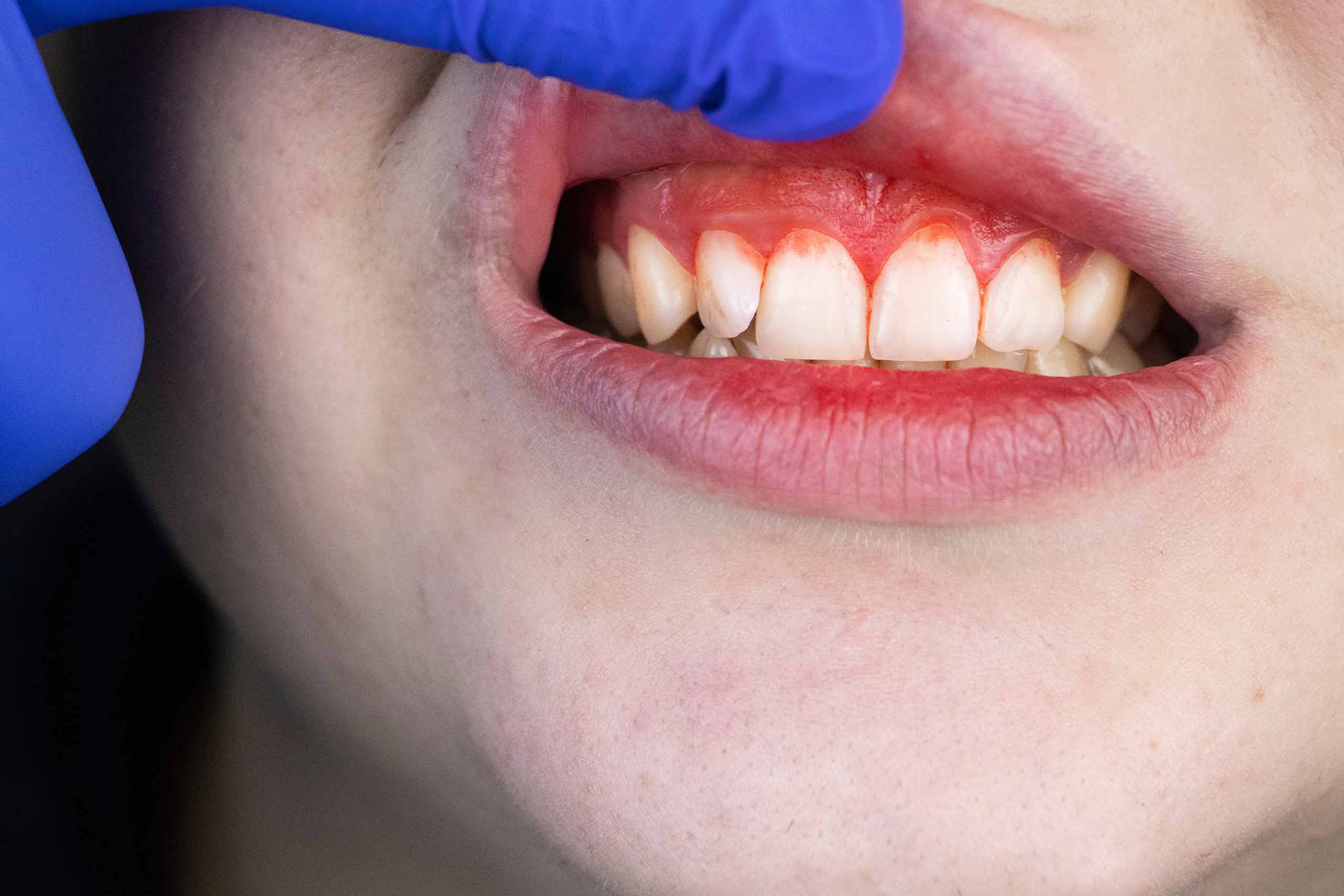 Periodontal (Gum) Disease – What is it and How do we treat it?