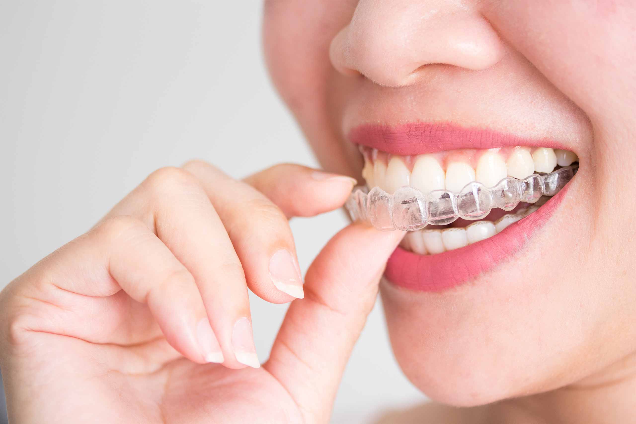 What You Need to Know About Invisalign in Singapore