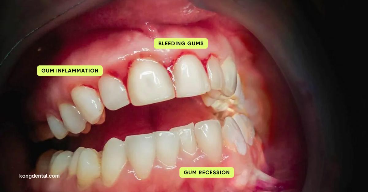 Gum Disease Symptoms | Kong Dental Surgery