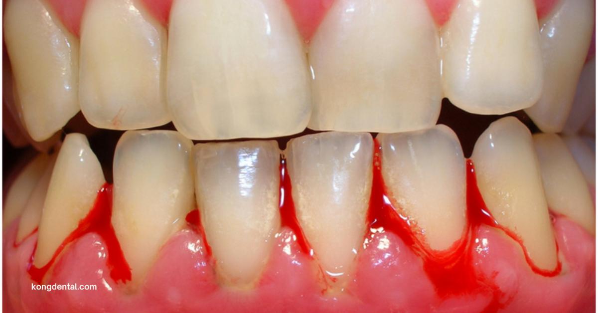 bleeding gum | Kong Dental Surgery