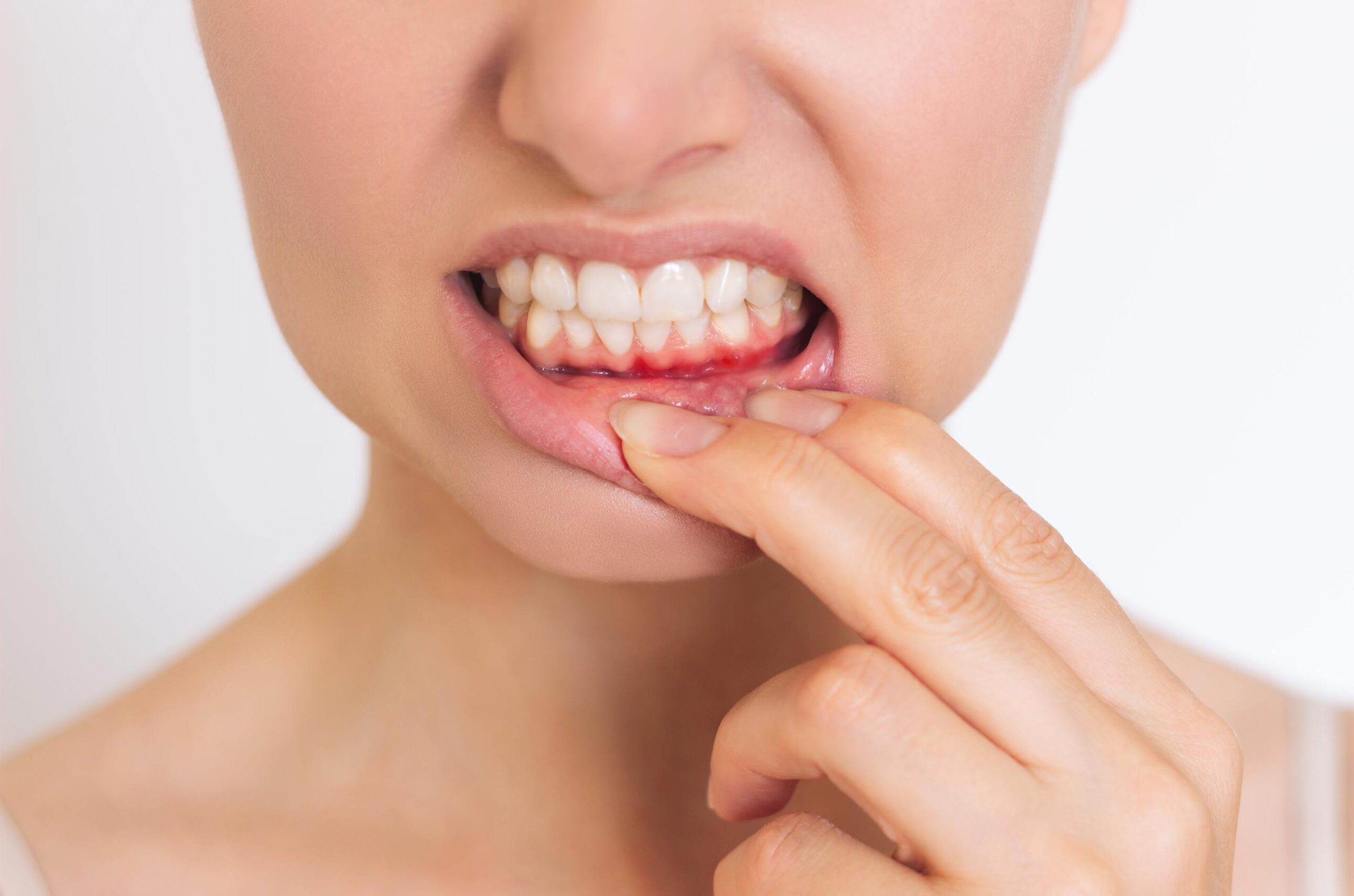 5 Early Warning Signs of Gum Disease You Shouldn’t Ignore