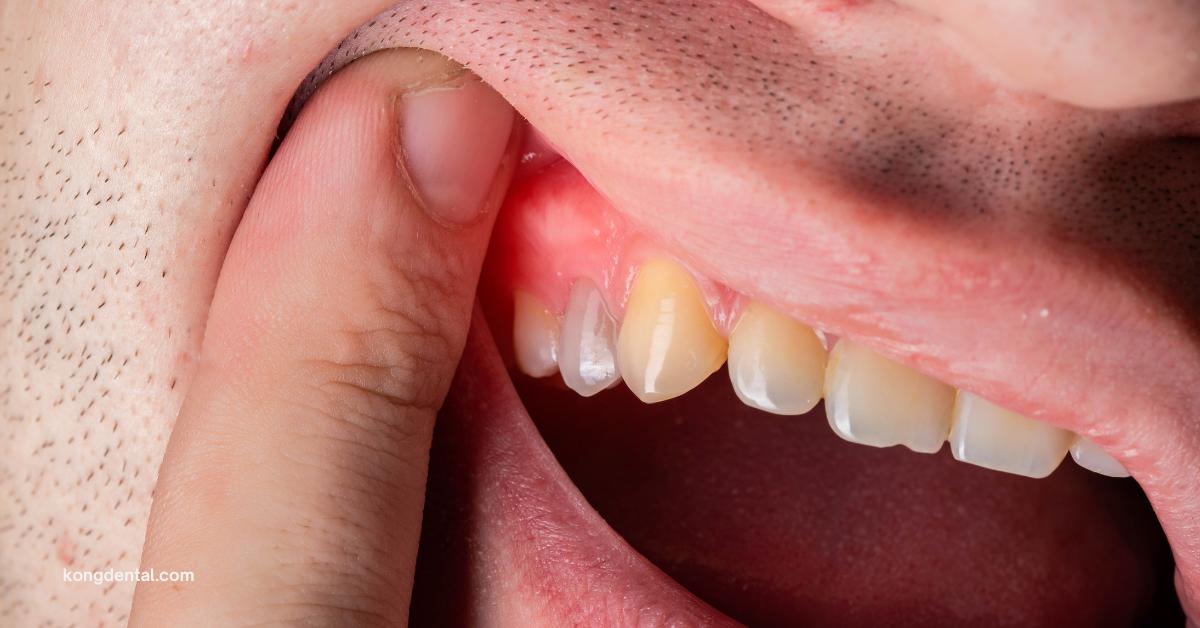 Swollen Gums | Kong Dental Surgery