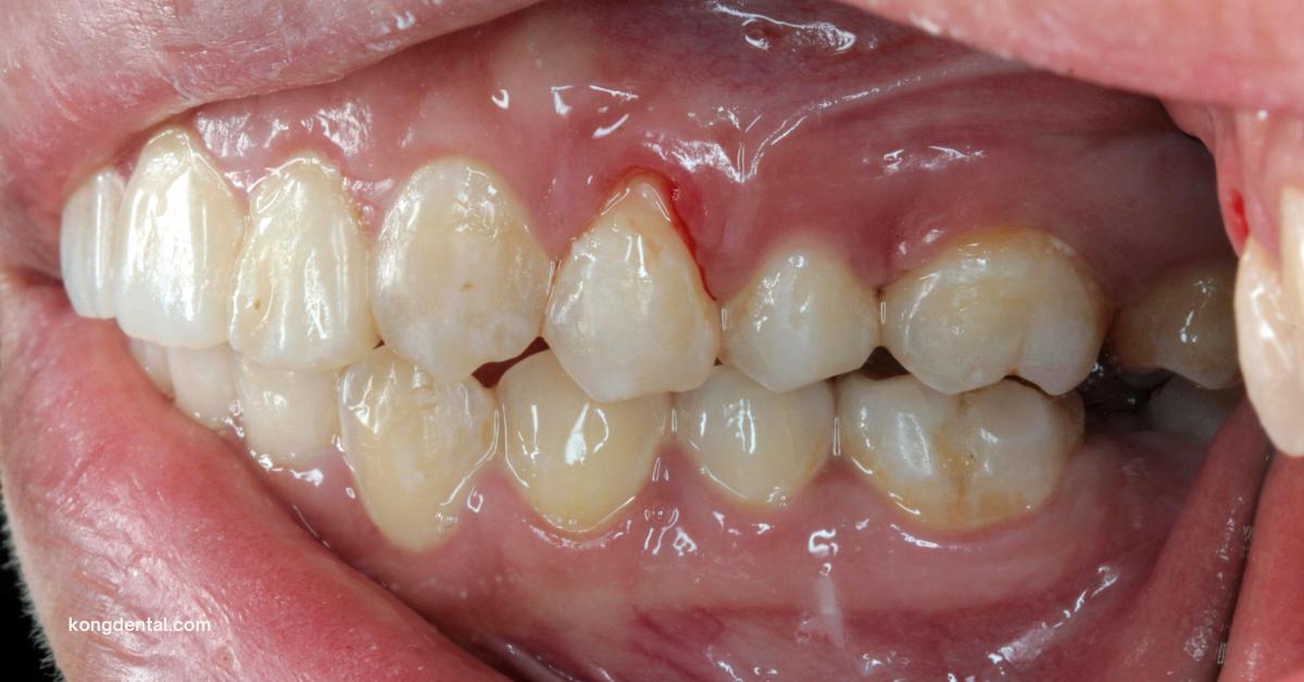 Receding Gums | Kong Dental Surgery