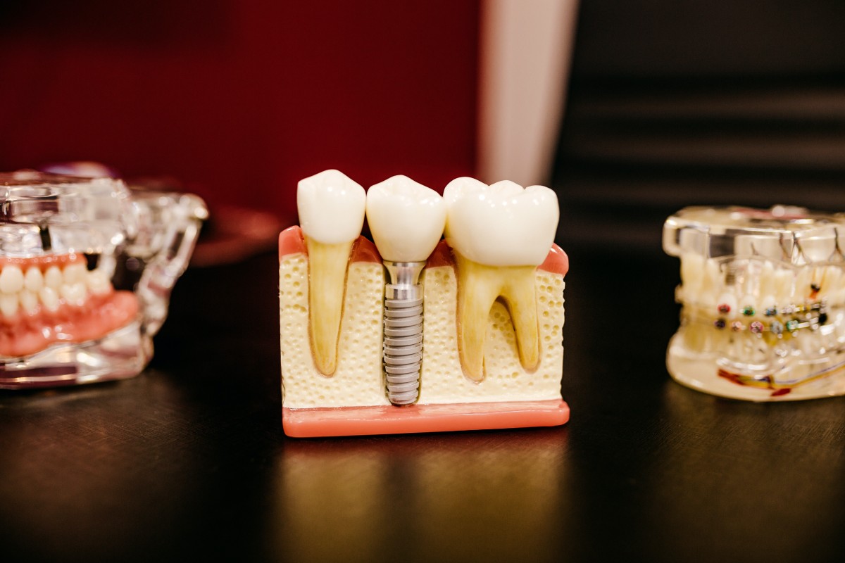 Dental implants with dental implant screw