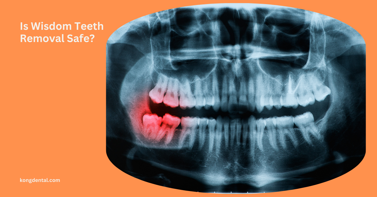 Is Wisdom Teeth Removal Safe | Kong Dental Surgery