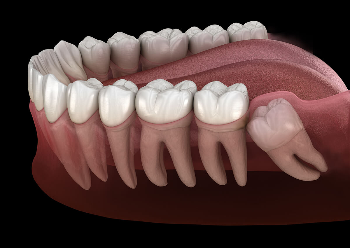 Is Wisdom Teeth Removal Safe?
