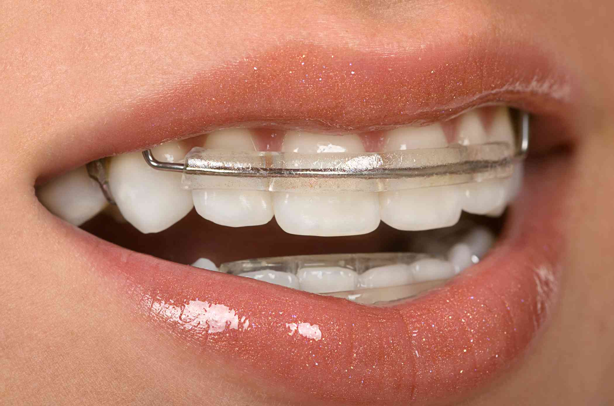 Metal retainers on teeth