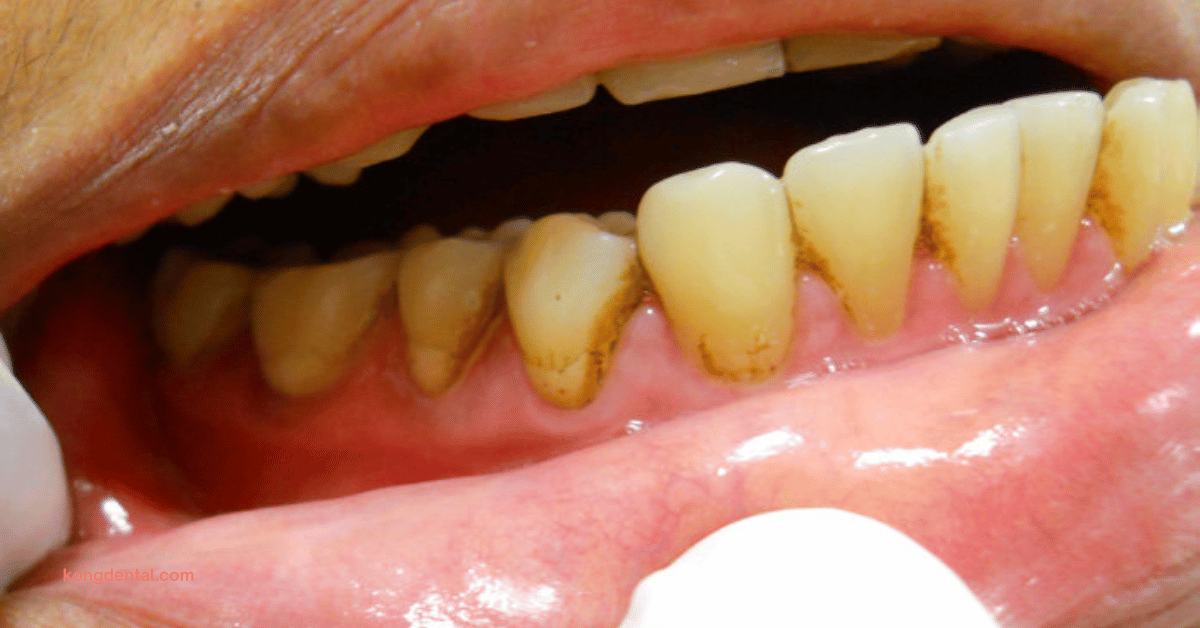 Tooth Discolouration (Stained Teeth) - Kong Dental Surgery