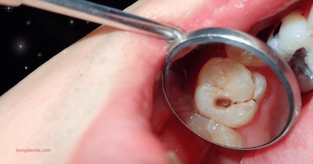 Dental Cavities on Tooth That Can Cause Toothache - Kong Dental Surgery