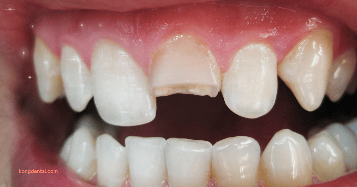 Cracked Tooth That Can Cause Tooth Sensitivity or Toothache - Kong Dental Surgery