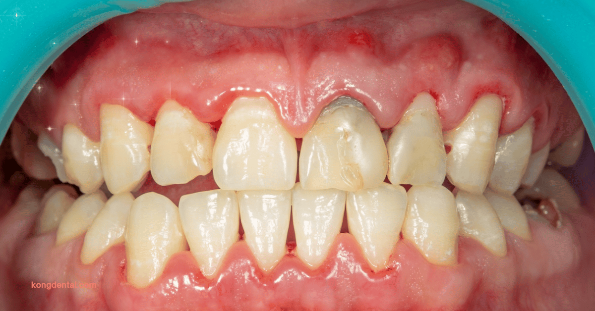 Progression of Gum Disease That Can Lead To Toothache - Kong Dental Surgery