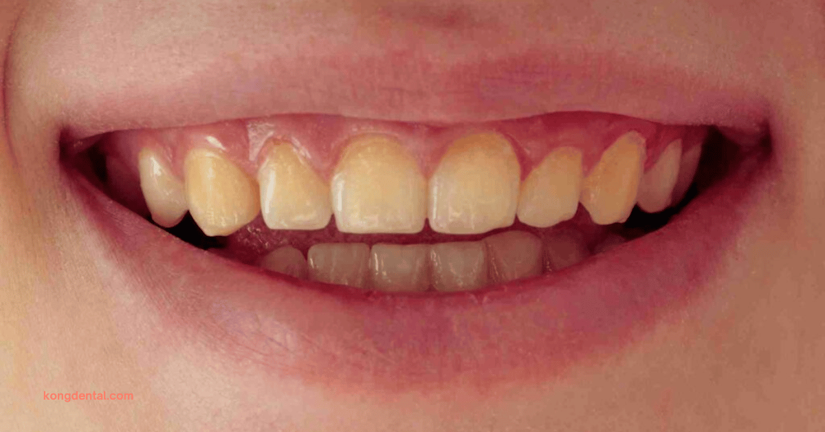 Yellow Tooth Discolouration - Kong Dental Surgery